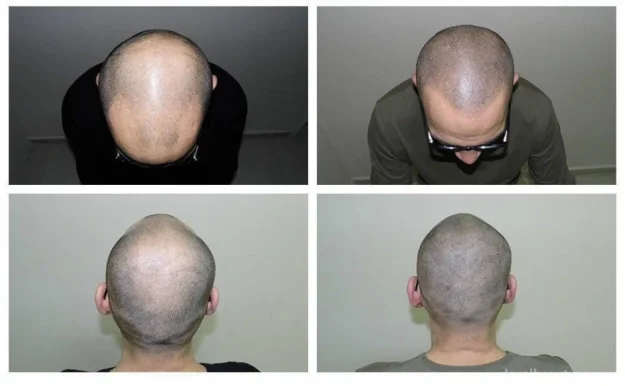The Bald Cure Vancouver Scalp Micropigmentation Kevin Harper, Burnaby - Photo 3