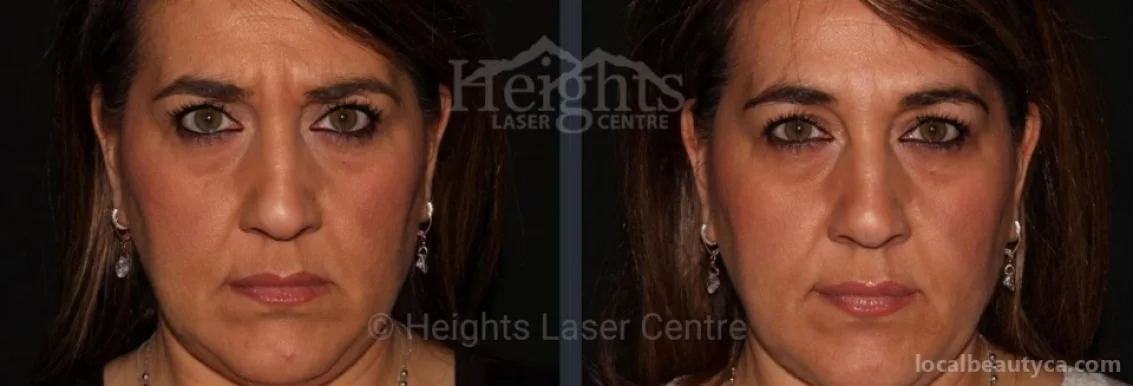 Heights Laser Centre, Burnaby - Photo 6