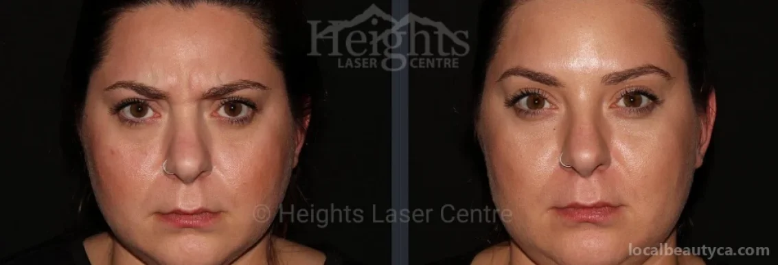 Heights Laser Centre, Burnaby - Photo 5