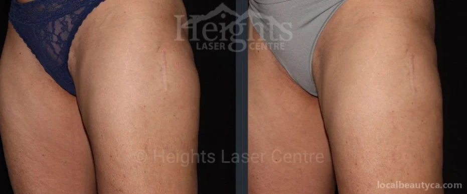 Heights Laser Centre, Burnaby - Photo 1