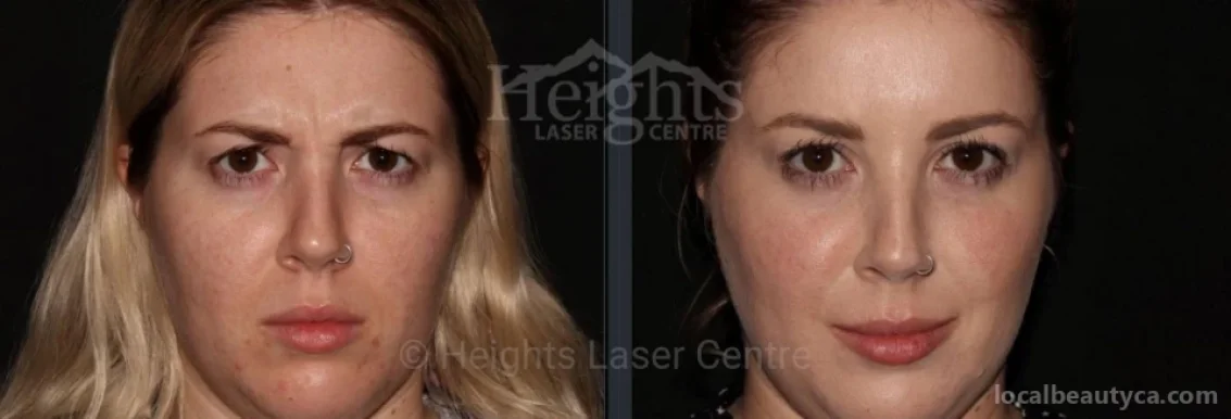 Heights Laser Centre, Burnaby - Photo 4