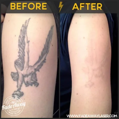 Removery Tattoo Removal & Fading, Kitchener - Photo 8