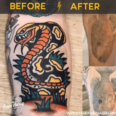 Removery Tattoo Removal & Fading, Kitchener - Photo 6