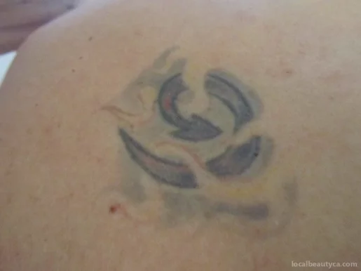 NUYU Laser Tattoo Removal, Montreal - Photo 1
