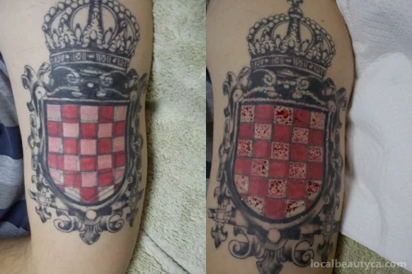 Zapit Tattoo Removal, Regina - Photo 2
