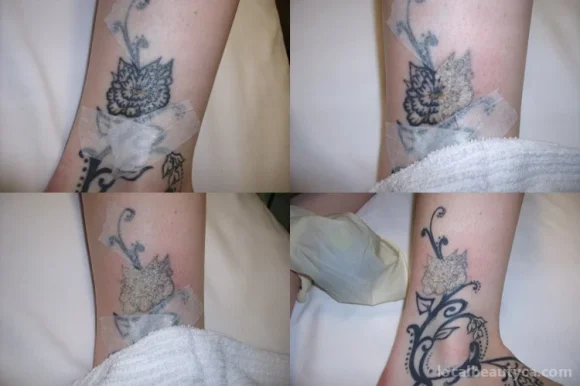 Zapit Tattoo Removal, Regina - Photo 6