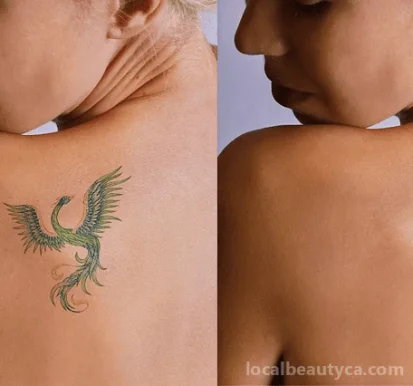 Tattoo Regret | Laser Tattoo Removal Richmond Hill, Richmond Hill - Photo 6