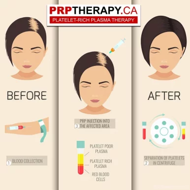 PRP Therapy | Platelet-Rich Plasma | Toronto, Toronto - Photo 3