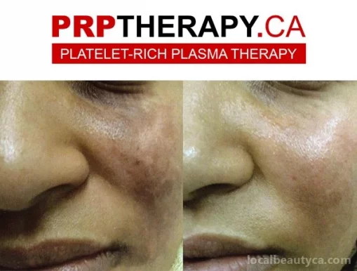 PRP Therapy | Platelet-Rich Plasma | Toronto, Toronto - Photo 1