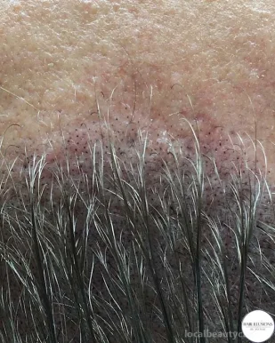 Hair Illusions - scalp micropigmentation experts, Toronto - Photo 1