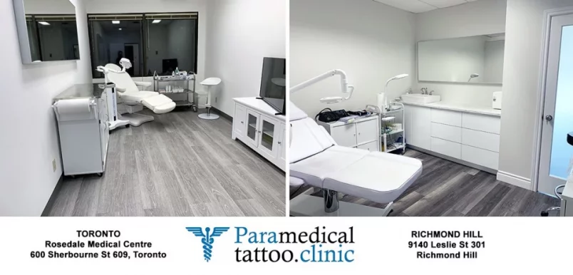 Tattoo Removal and Scalp Micropigmentation Hair Tattoo | Toronto, Toronto - 