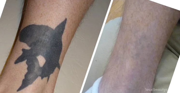 Fading Fast Laser Tattoo Removal, Toronto - Photo 3